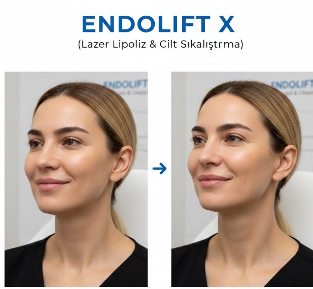 Endolift X (lazer lipoliz & cilt sıkılaştırma)