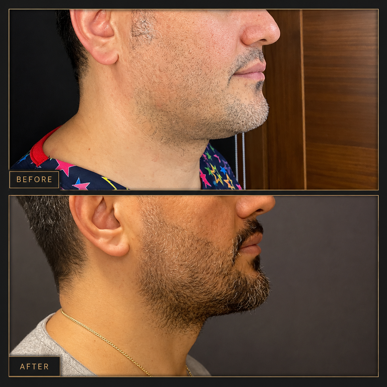 non surgical face lift ultherapy before after mid 40s male patient