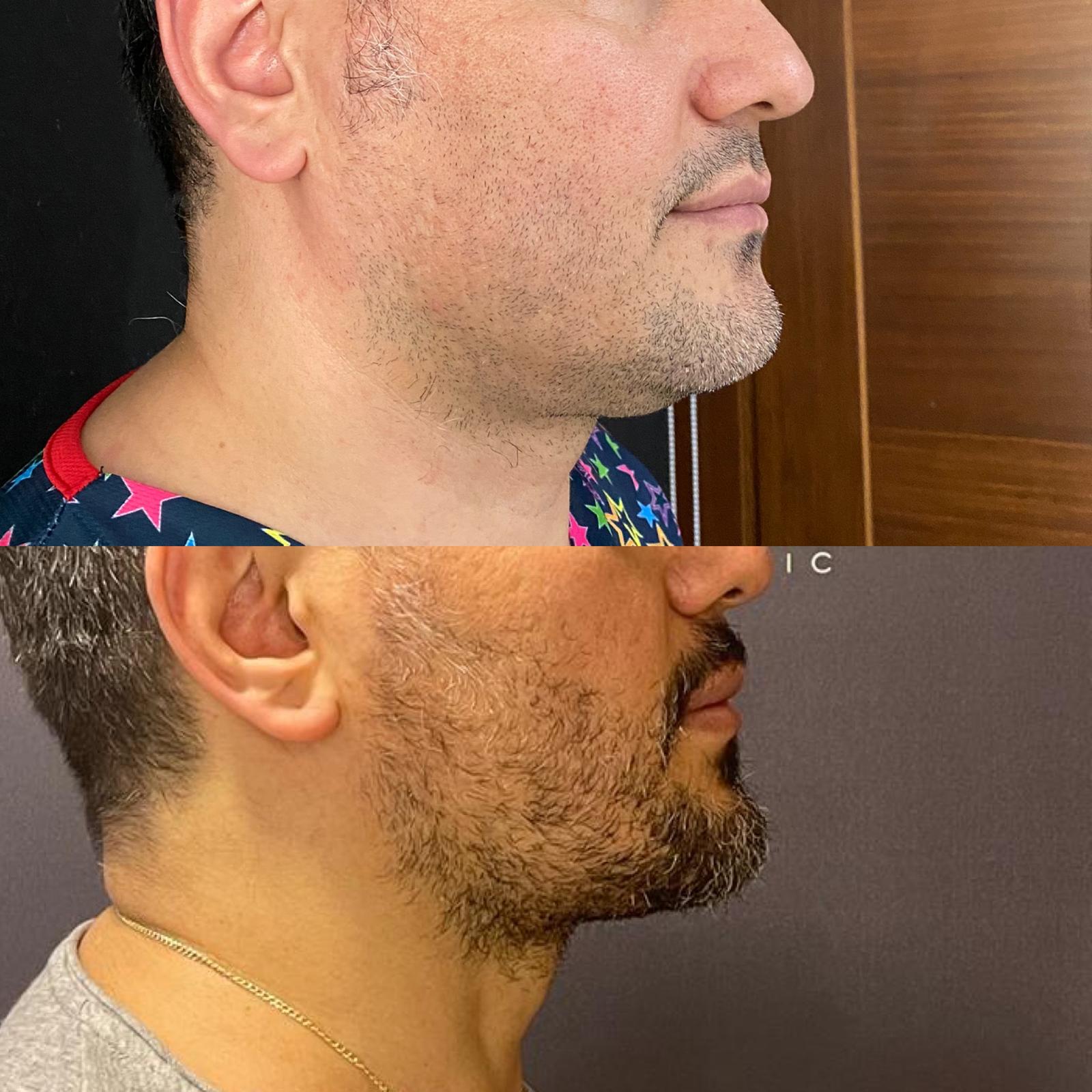 ultherapy before after double chin male 40s one session 1 week after treatment
