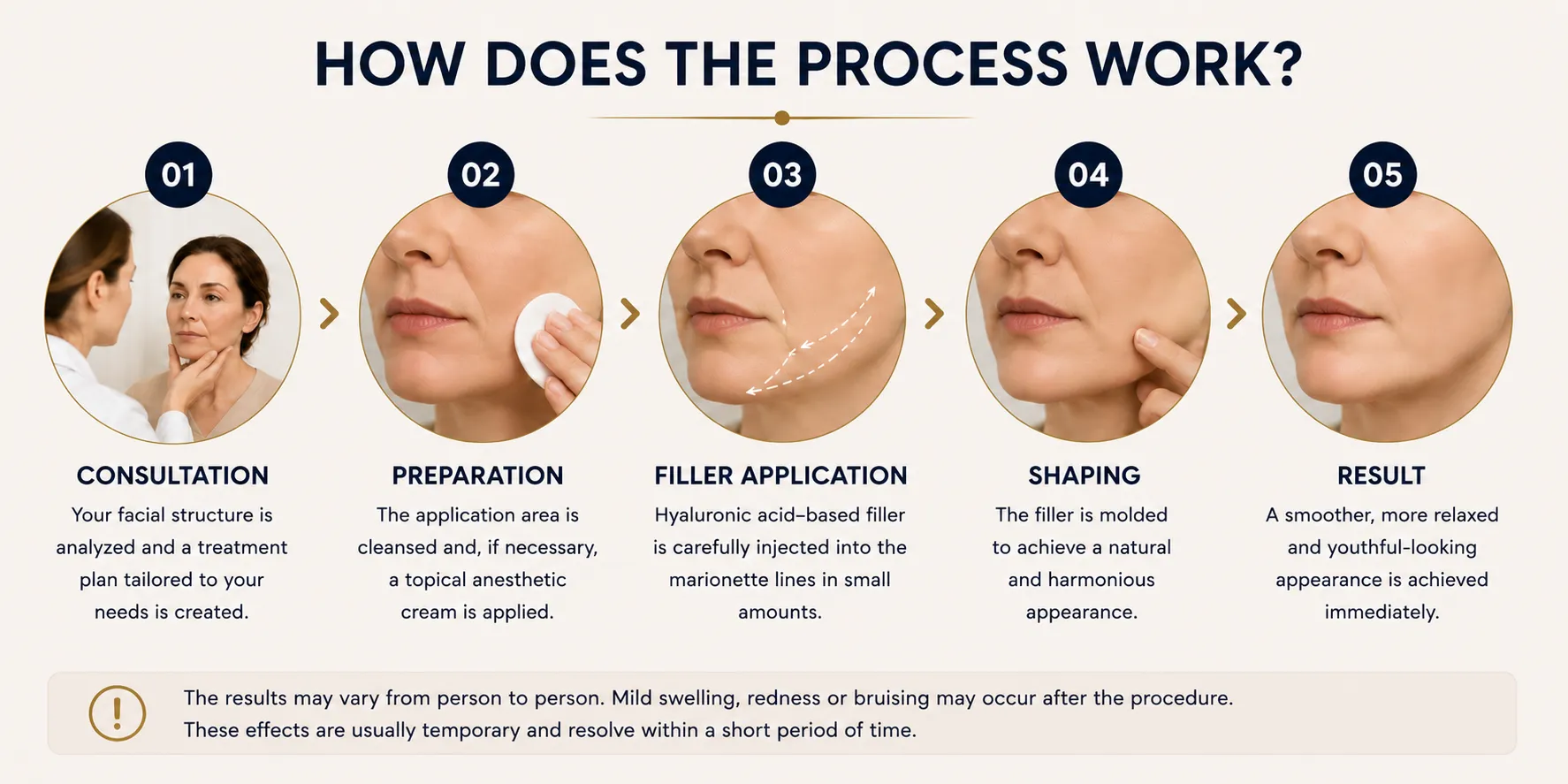 Marionette filler process in Istanbul with lower face analysis volume loss evaluation and natural planning