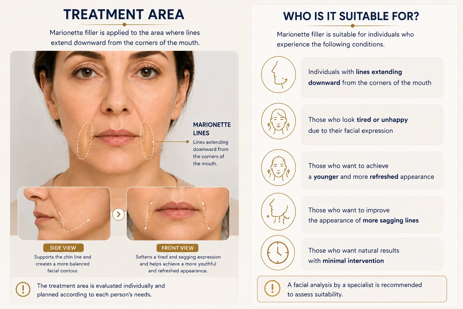 Marionette filler treatment areas around mouth corners lower face and expected results Istanbul