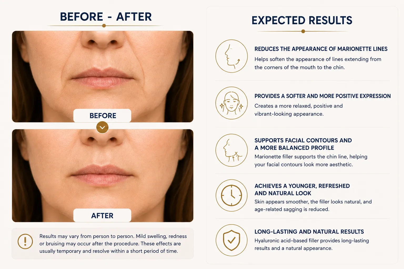 Marionette filler before and after concept for mouth corner lines and natural expression support Istanbul Levent