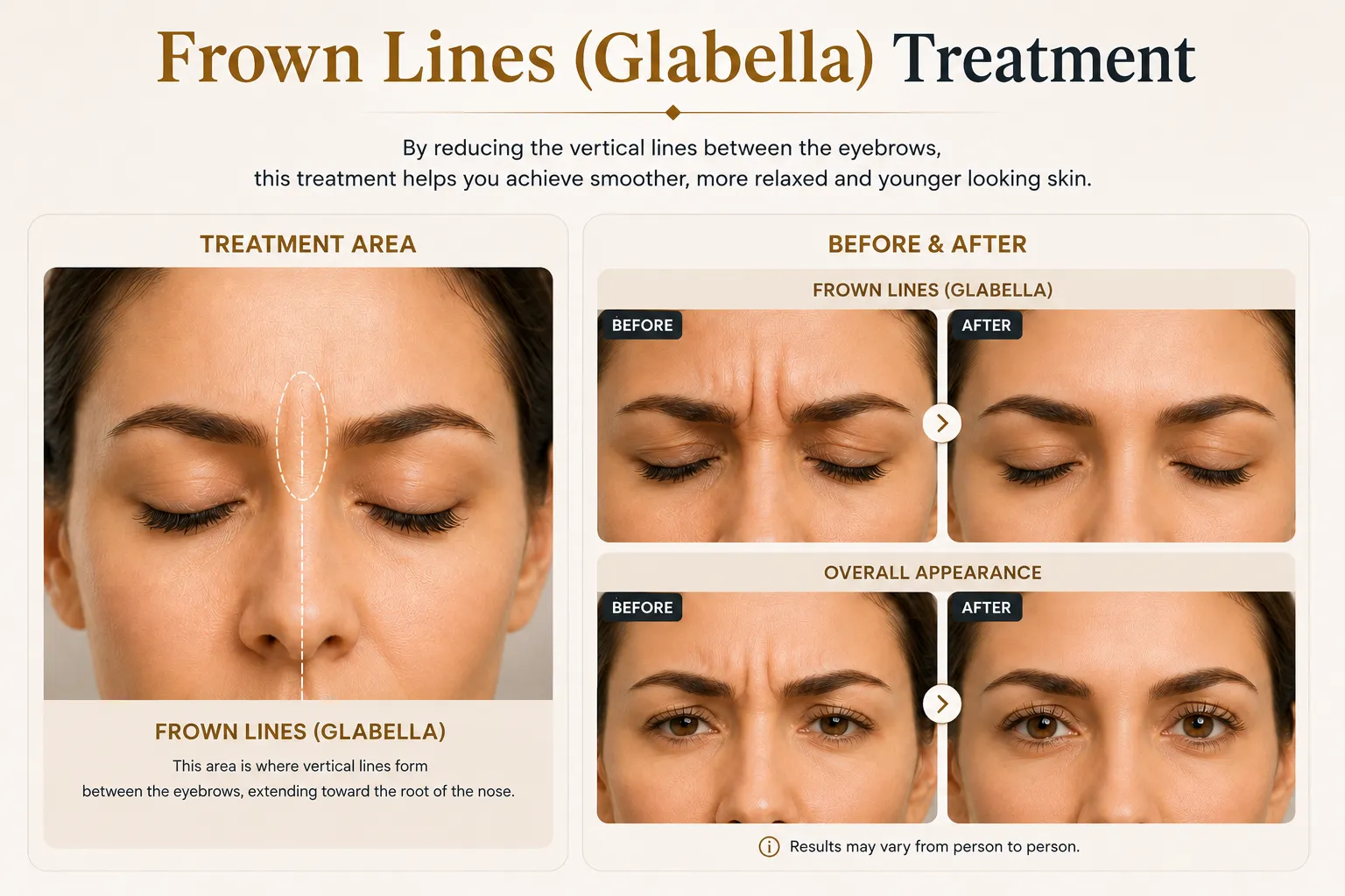 Frown Lines Botox before and after concept for glabella lines and relaxed expression Istanbul Levent