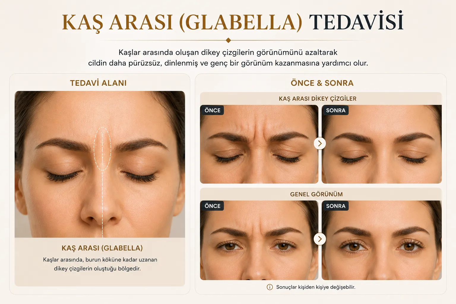 Kaş arası botoksu &ouml;nce sonrası glabella &ccedil;izgileri ve daha dengeli ifade Istanbul Levent