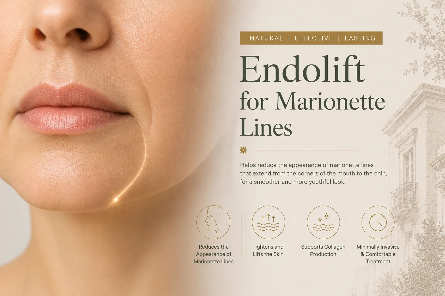 Nasolabial Endolift